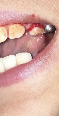 a person's mouth with a tooth missing