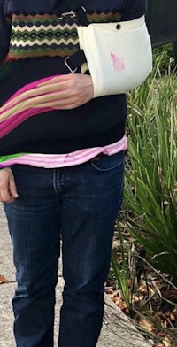 a woman with a broken arm standing on a sidewalk