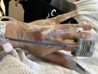 a person's hand with an iv drip attached to it