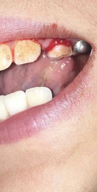 a person's mouth with a tooth missing